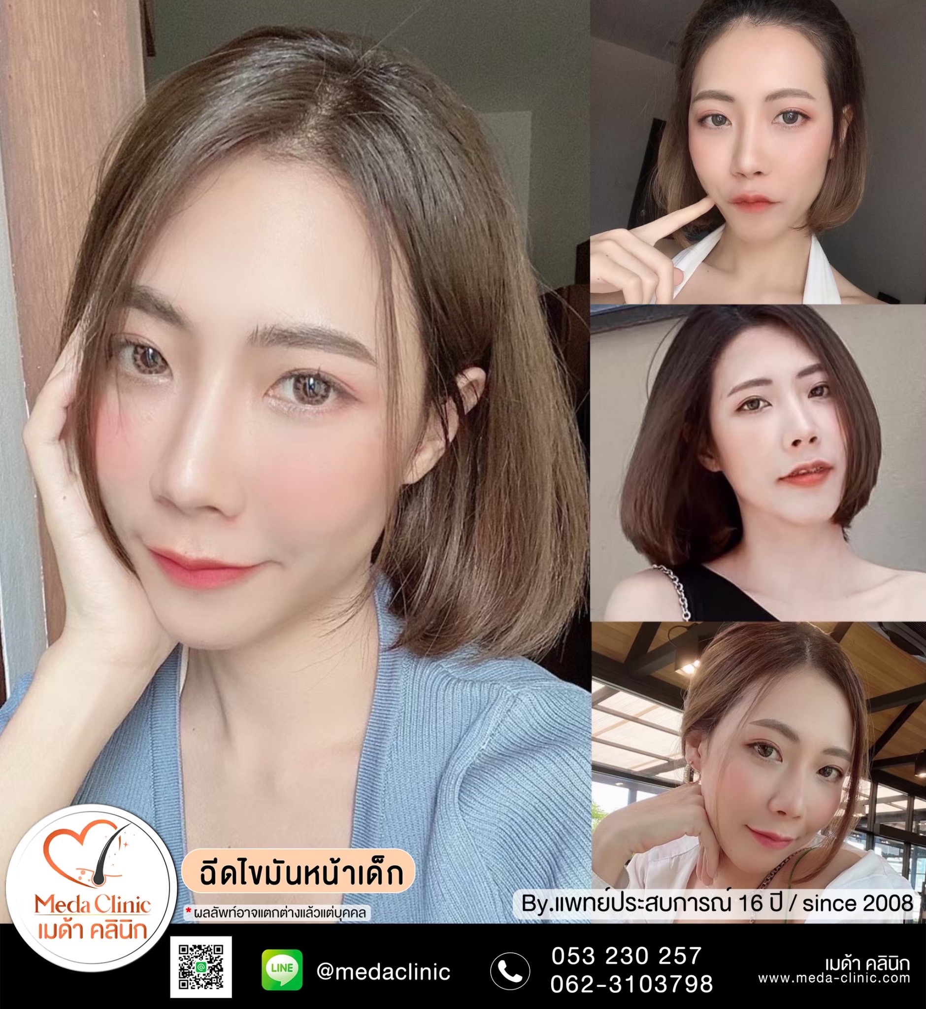 ฉีด fat หน้า เชียงใหม่