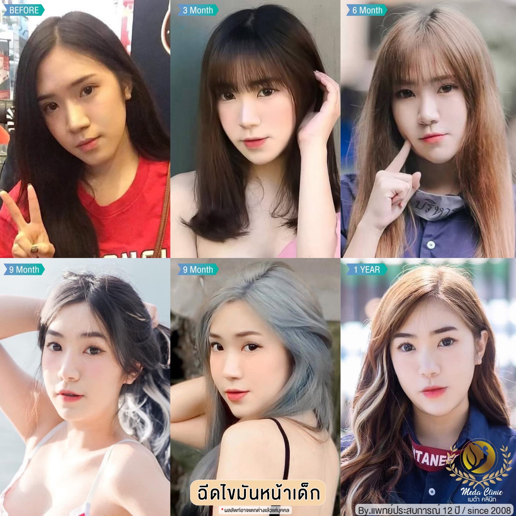 ฉีด fat หน้า เชียงใหม่