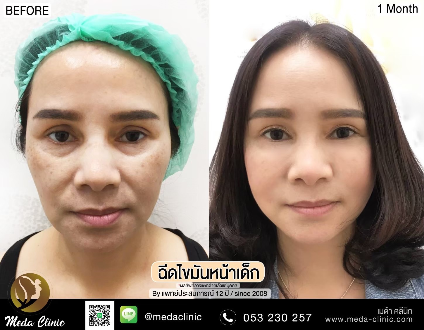 ฉีด fat หน้า เชียงใหม่