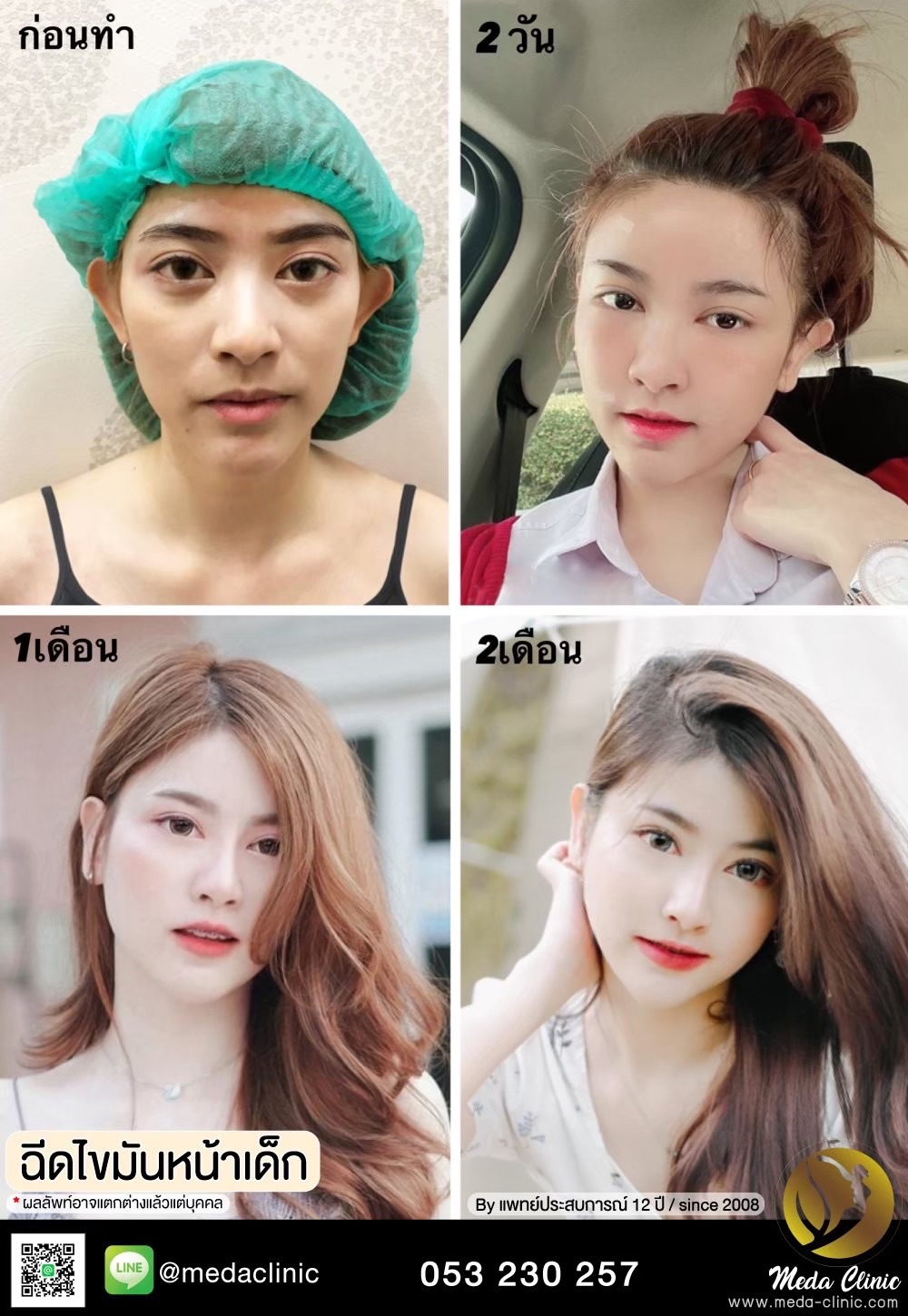 ฉีด fat หน้า เชียงใหม่