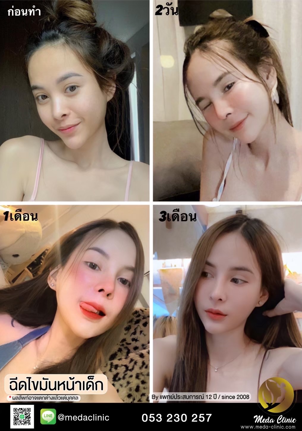 ฉีด fat หน้า เชียงใหม่