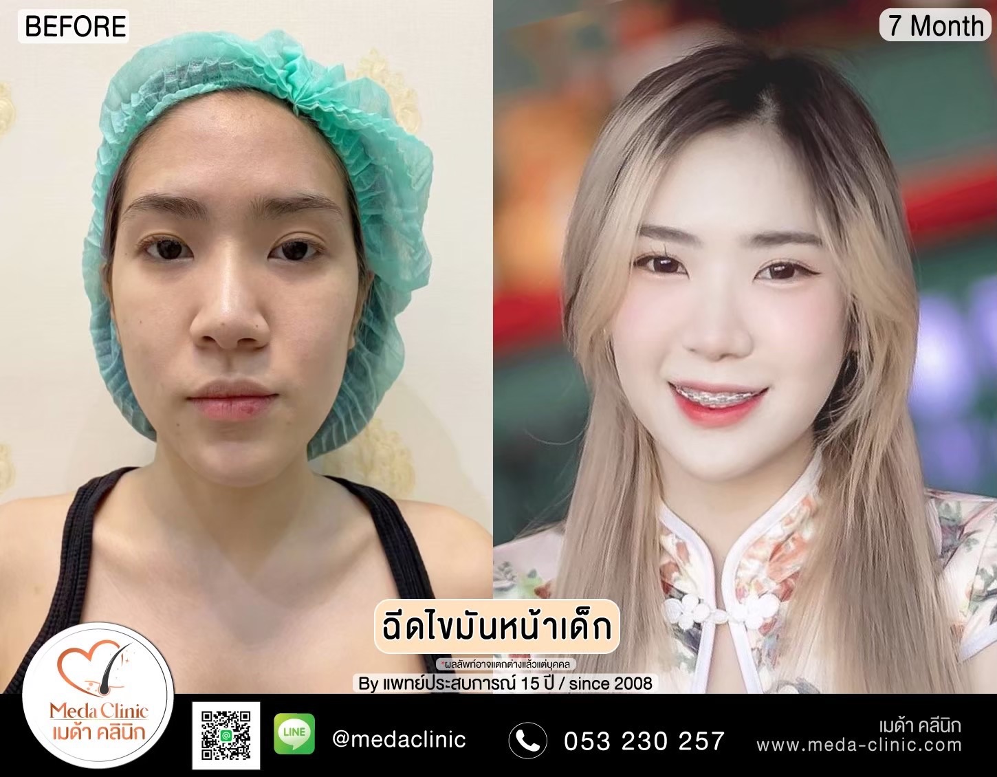 ฉีด fat หน้า เชียงใหม่