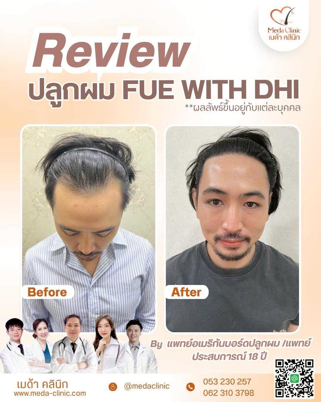 ABHRS hair transplant Thailand