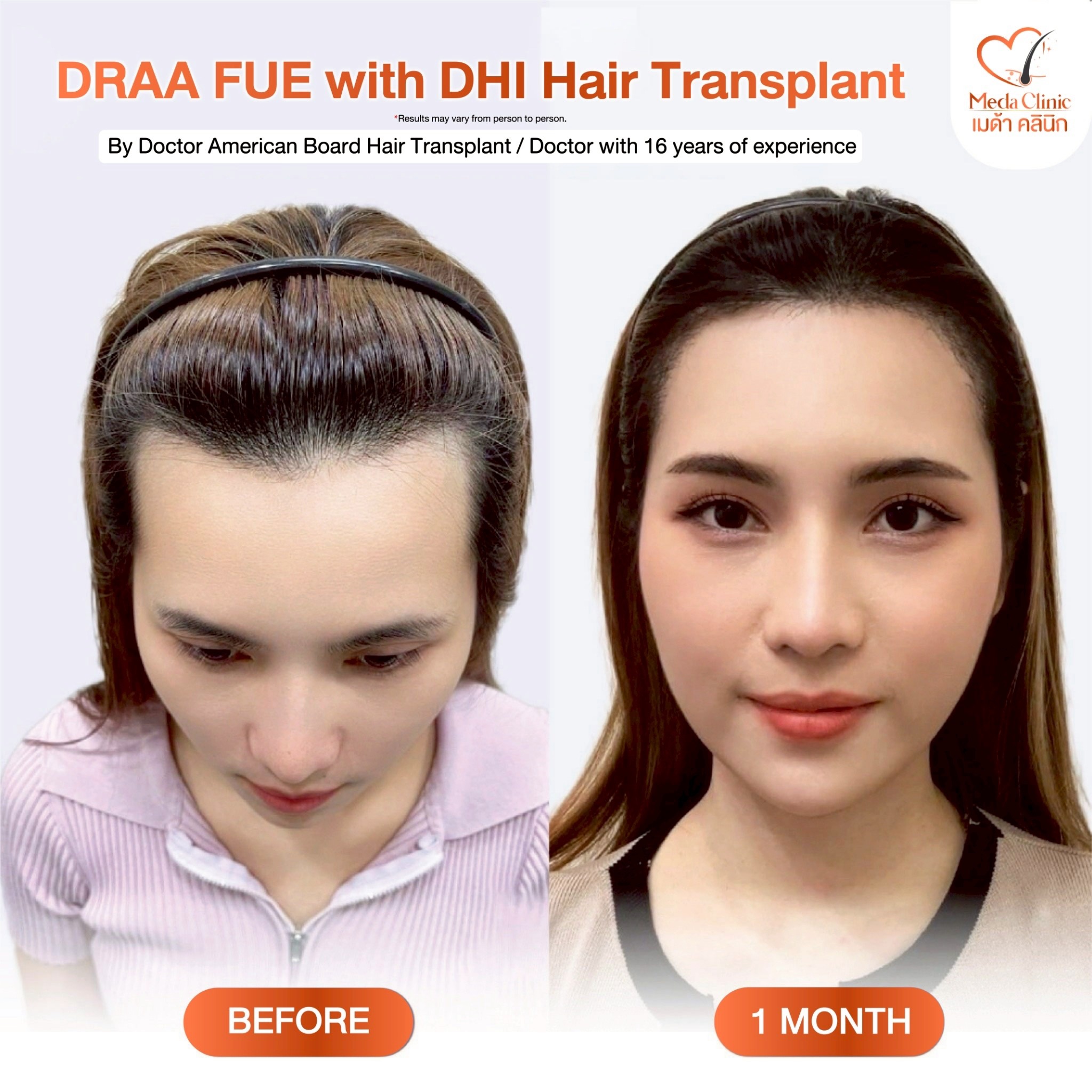 ABHRS hair transplant Thailand