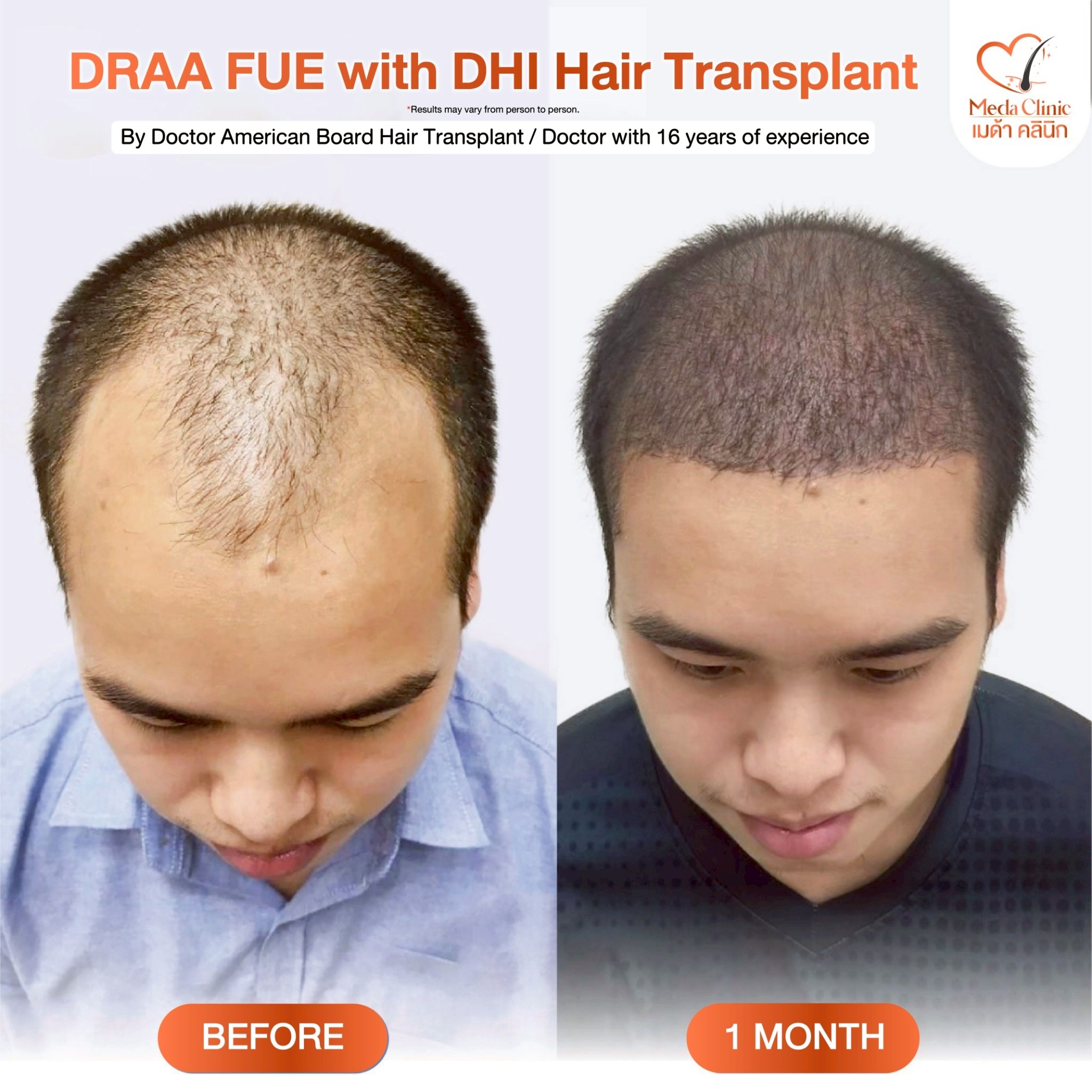 ABHRS hair transplant Thailand
