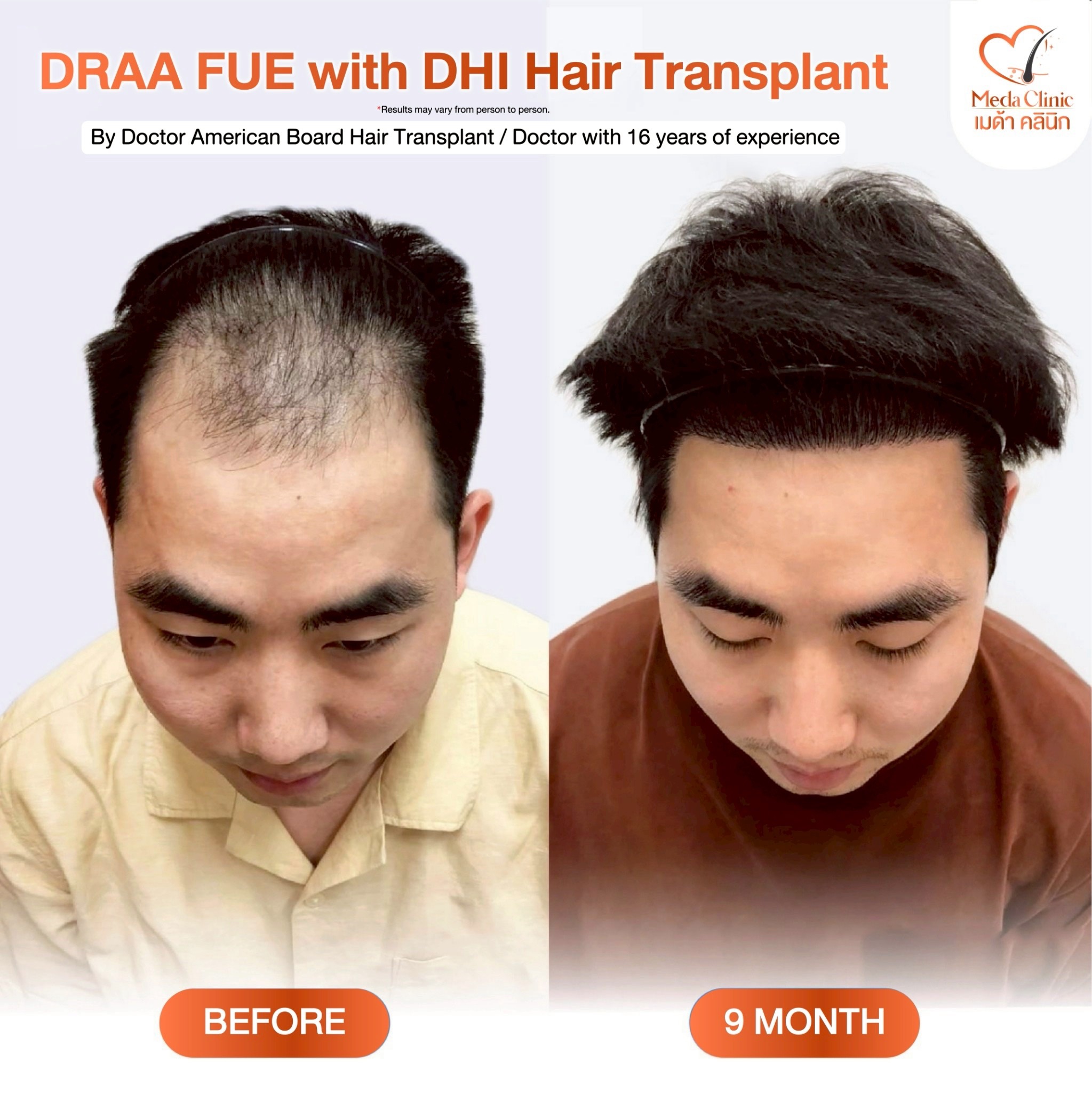 ABHRS hair transplant Thailand