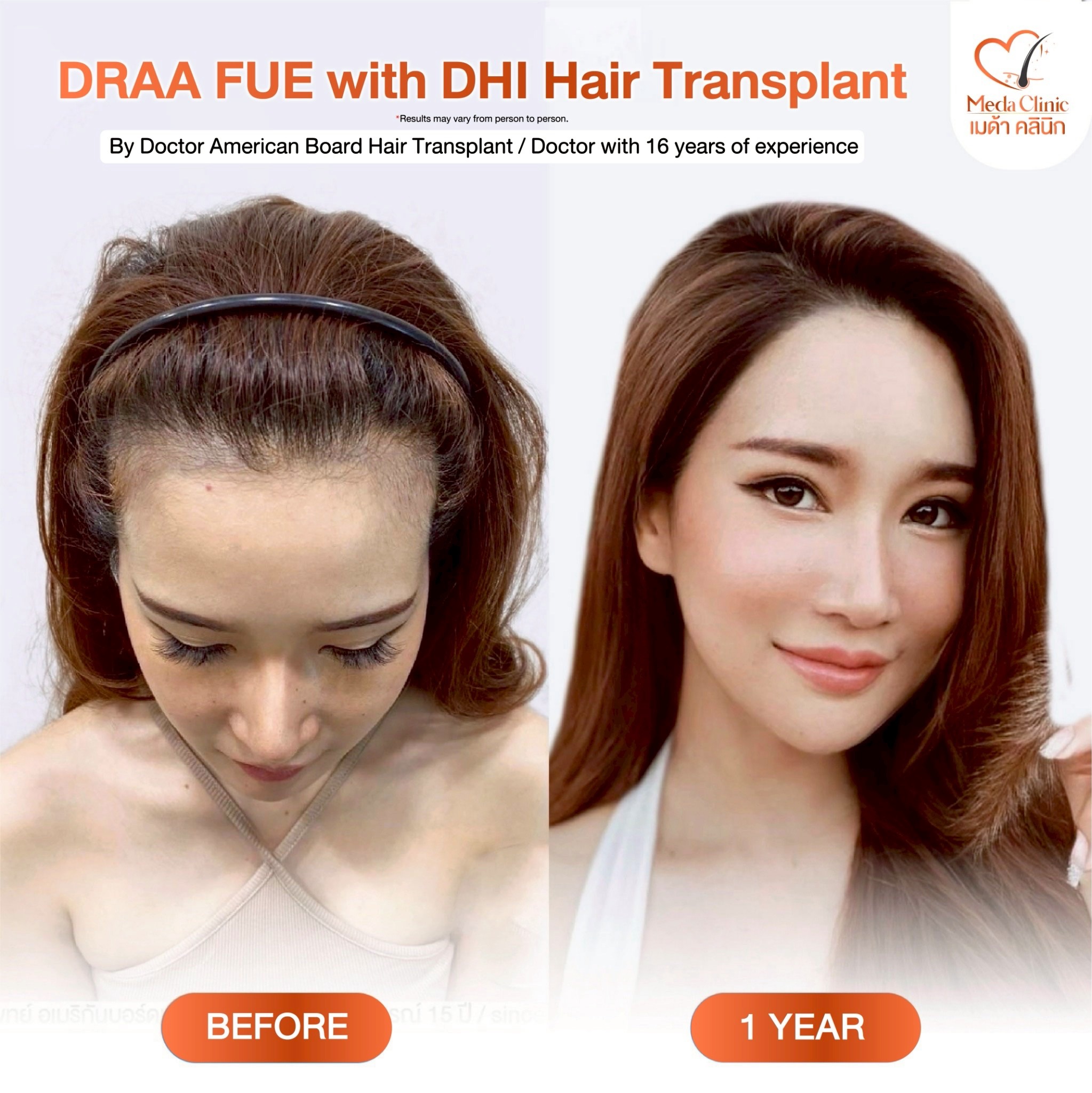 ABHRS hair transplant Thailand