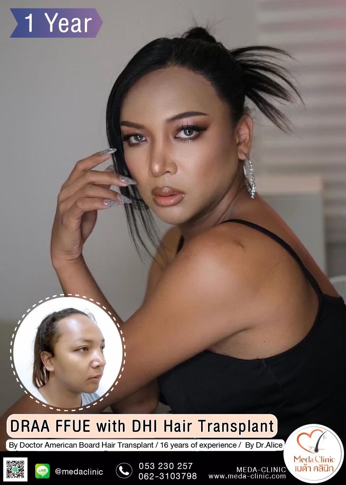 ABHRS hair transplant Thailand