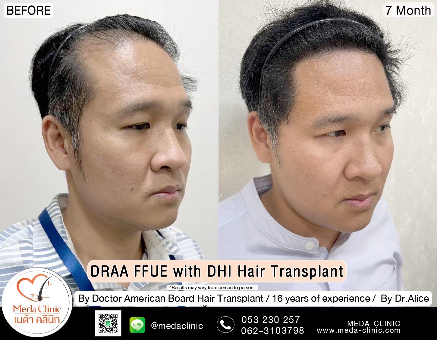 ABHRS hair transplant Thailand