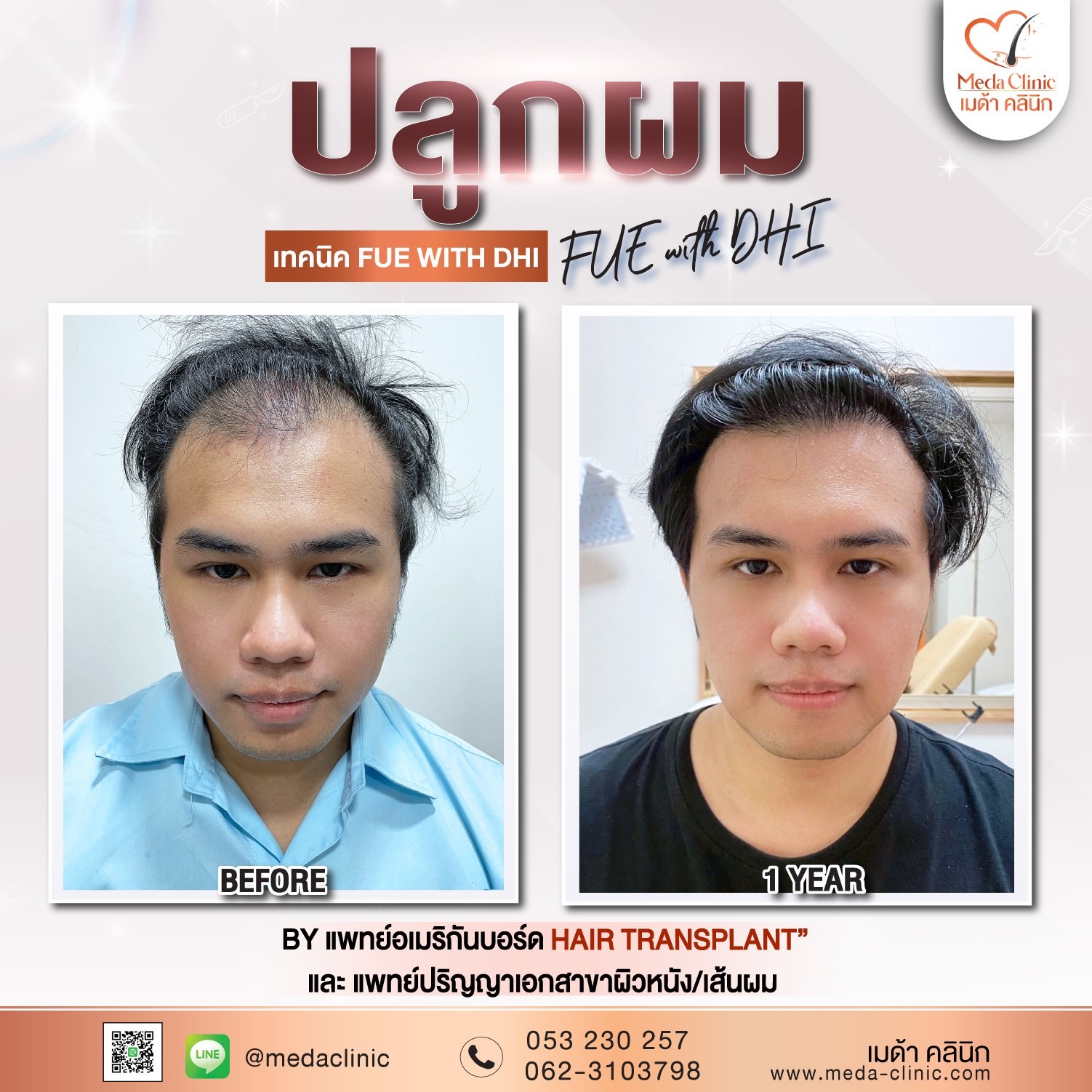 ABHRS hair transplant Thailand