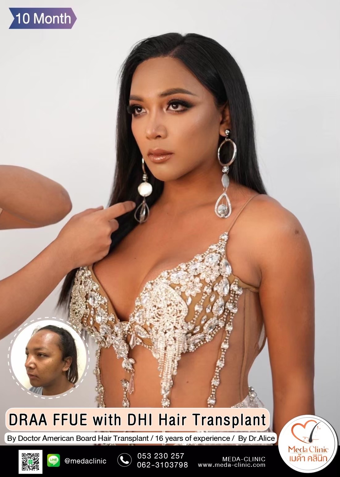 ABHRS hair transplant Thailand