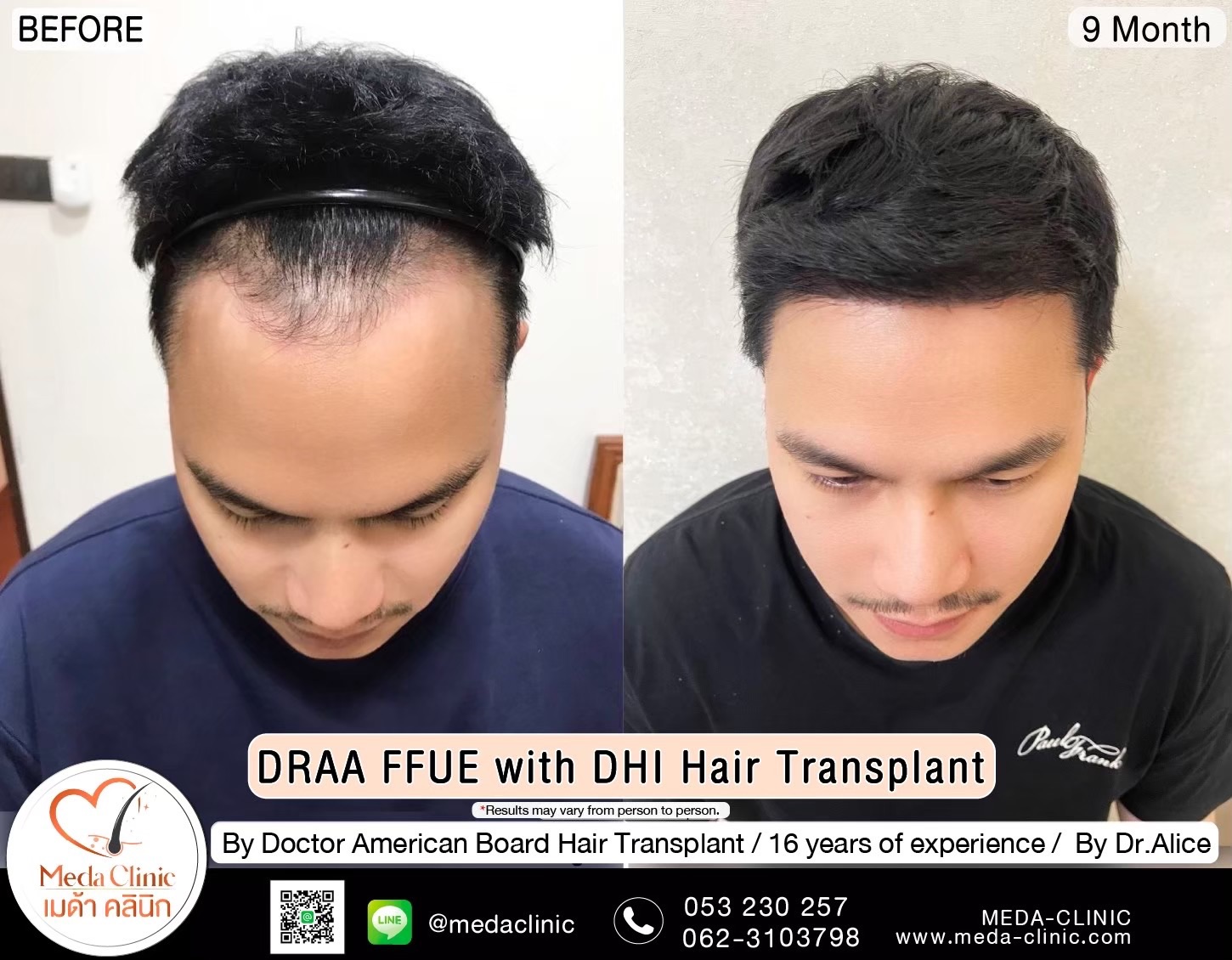 ABHRS hair transplant Thailand