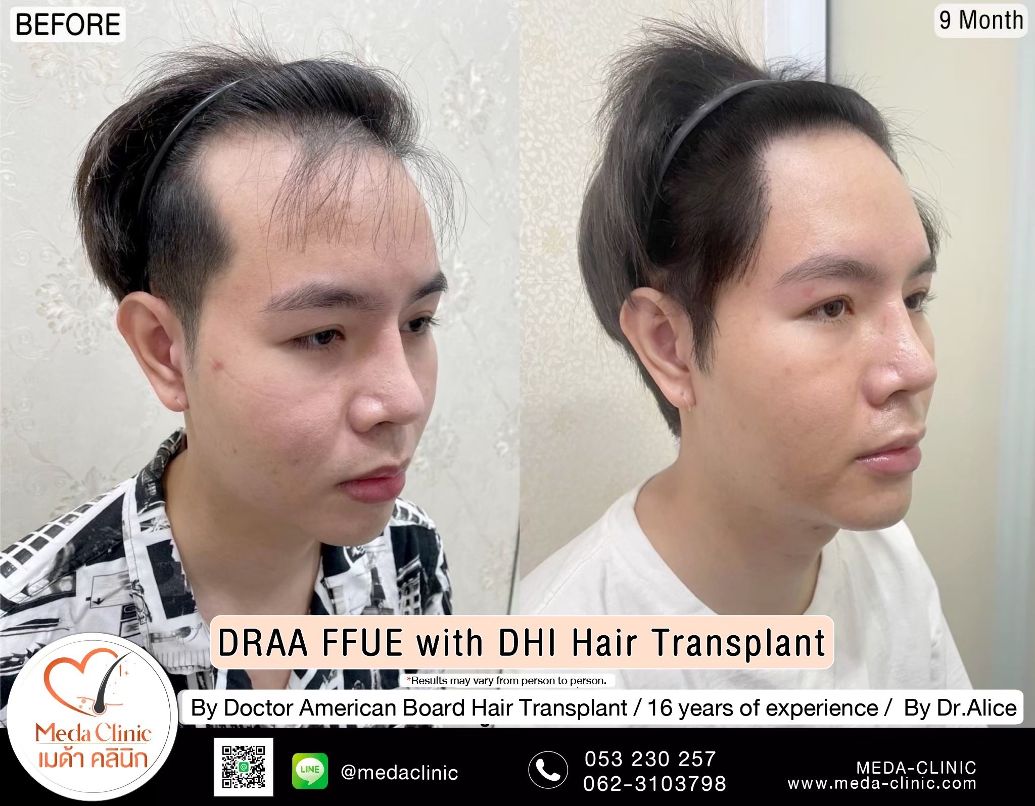 ABHRS hair transplant Thailand