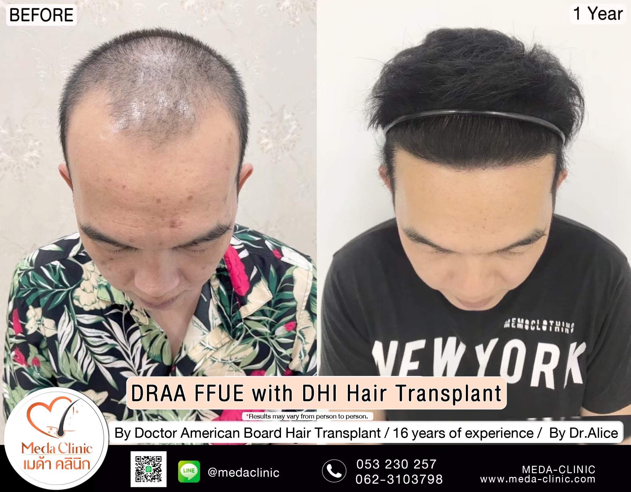 ABHRS hair transplant Thailand
