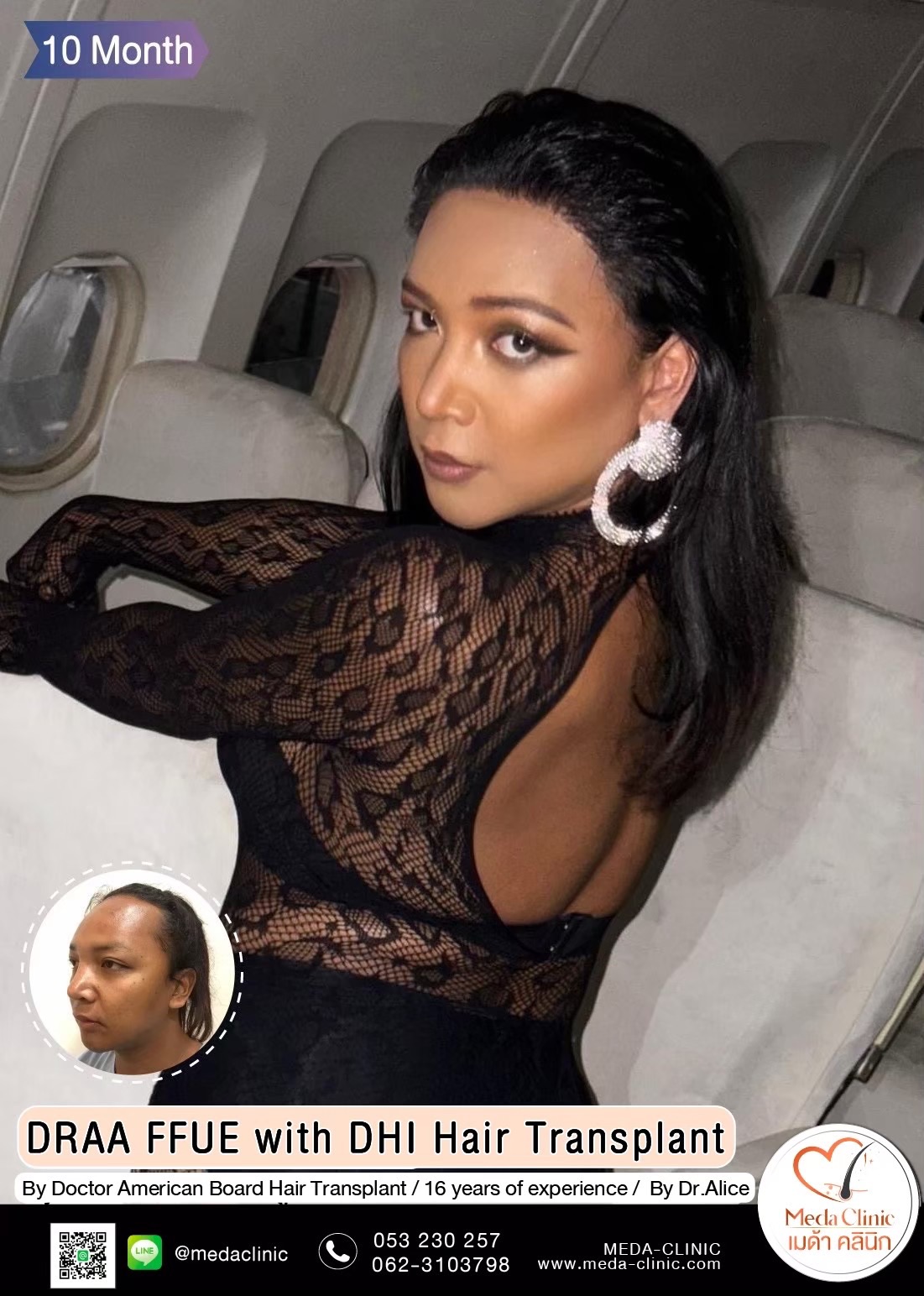 ABHRS hair transplant Thailand