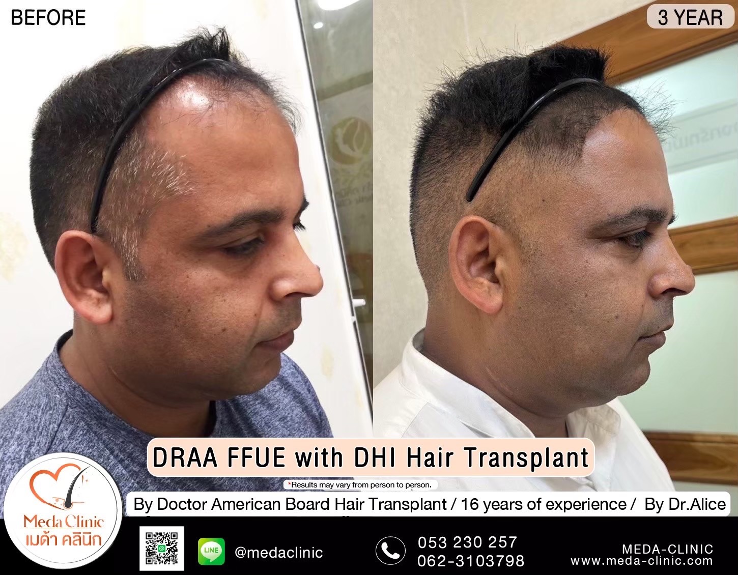 ABHRS hair transplant Thailand
