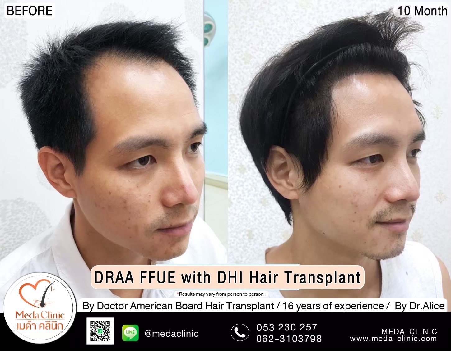 ABHRS hair transplant Thailand