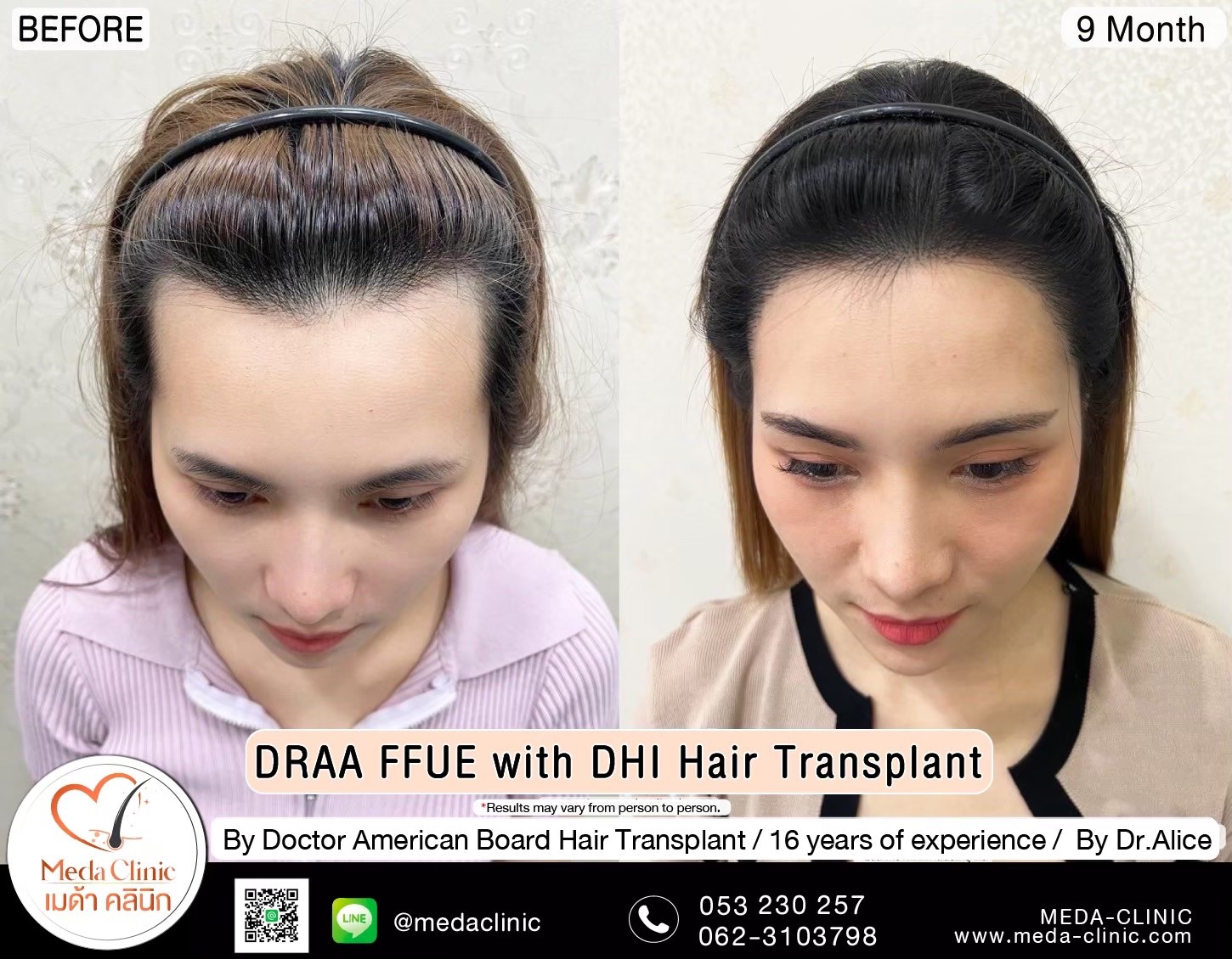 ABHRS hair transplant Thailand