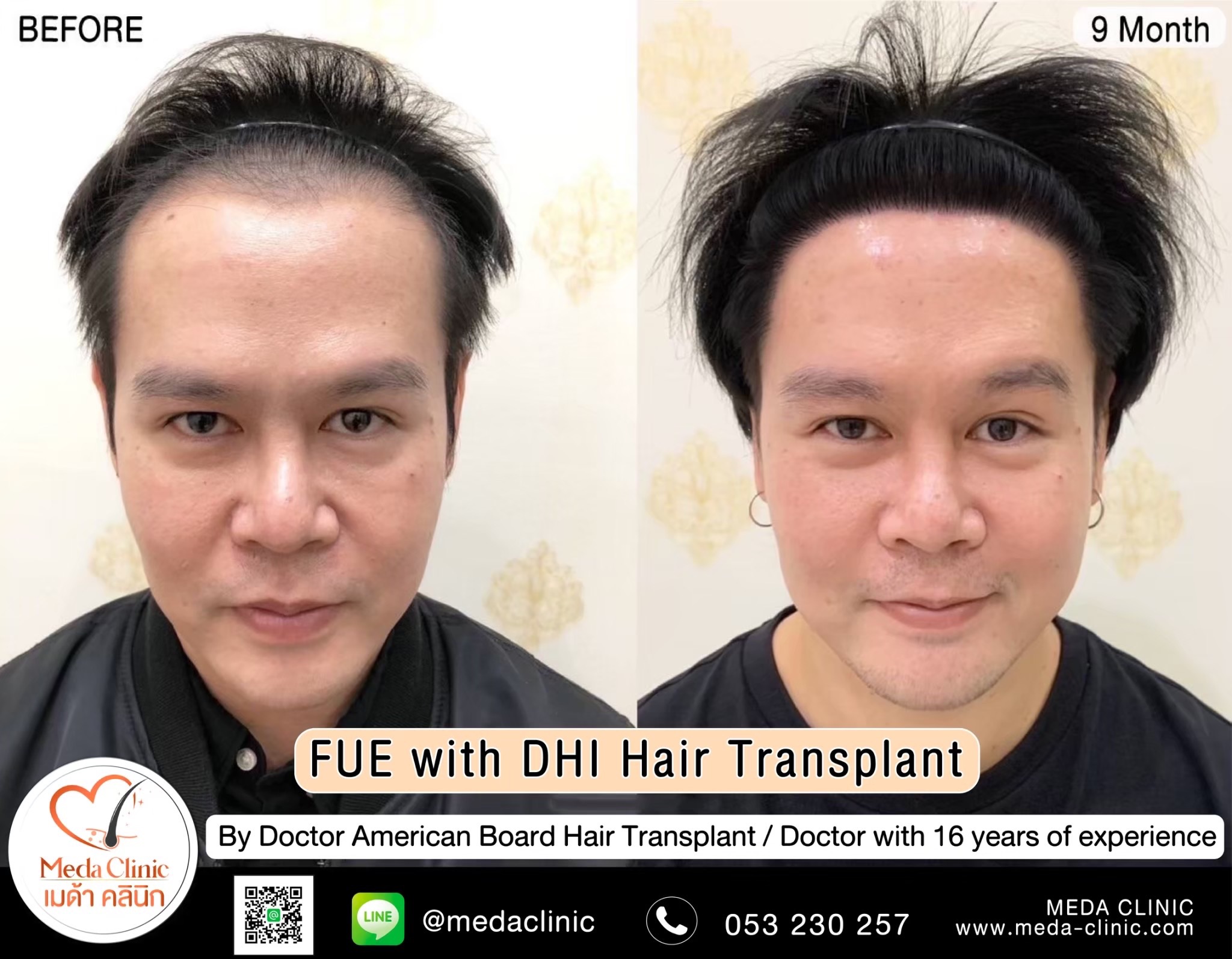 ABHRS hair transplant Thailand