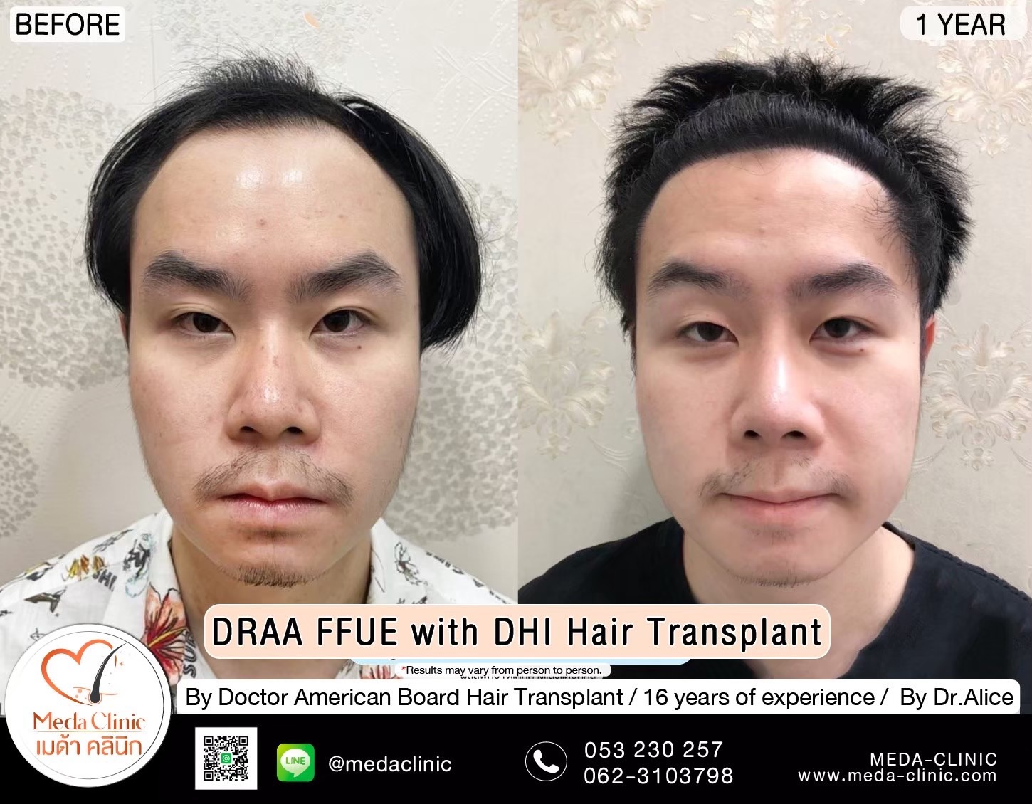 ABHRS hair transplant Thailand