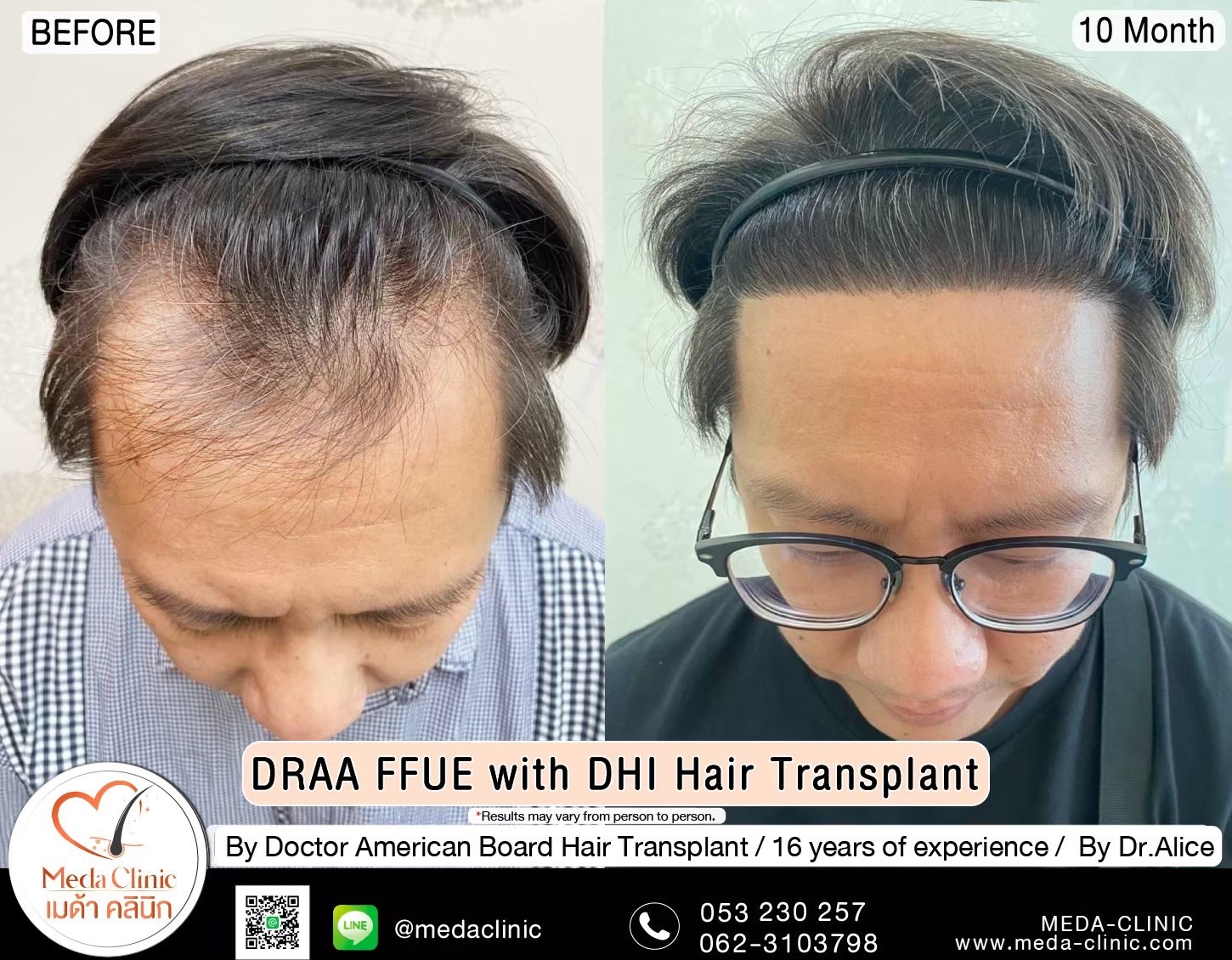 ABHRS hair transplant Thailand