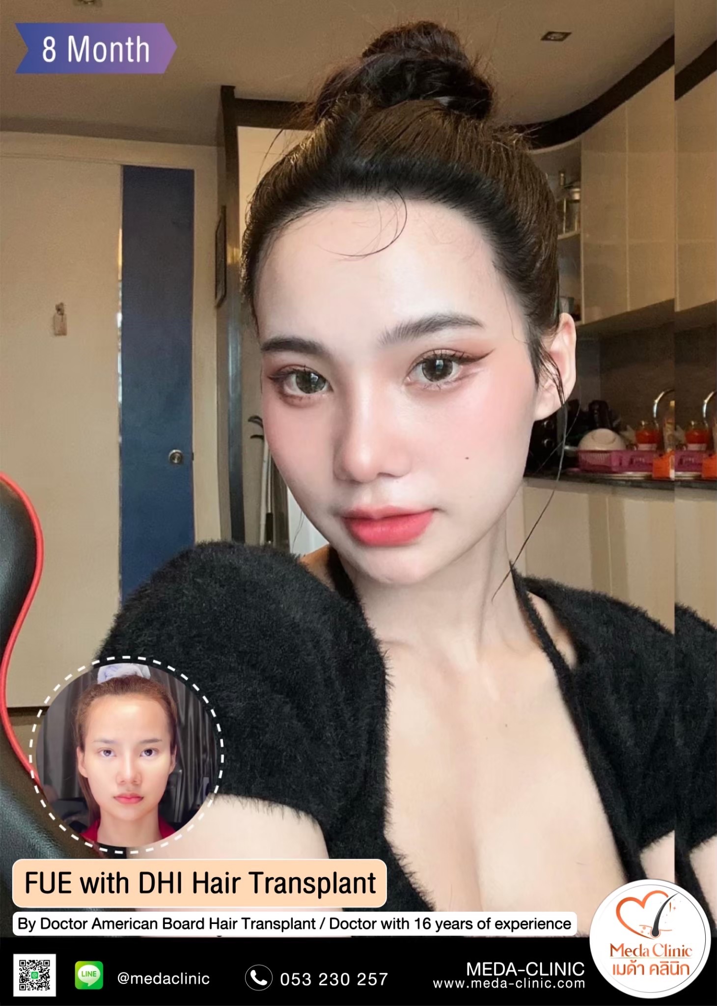 ABHRS hair transplant Thailand