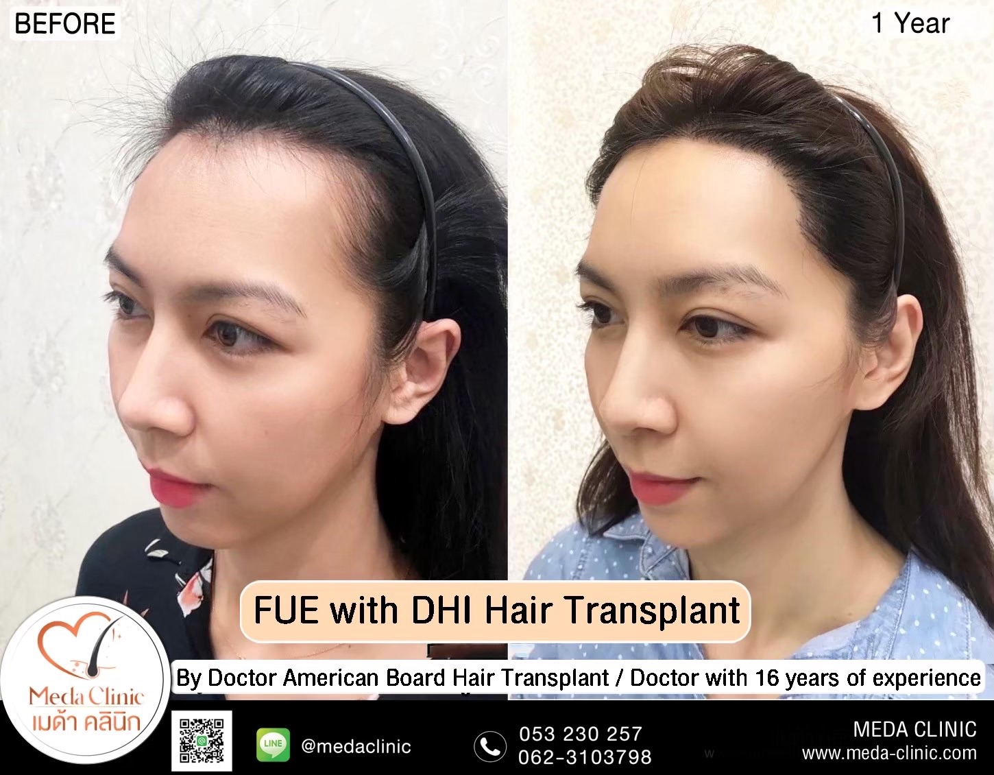 ABHRS hair transplant Thailand