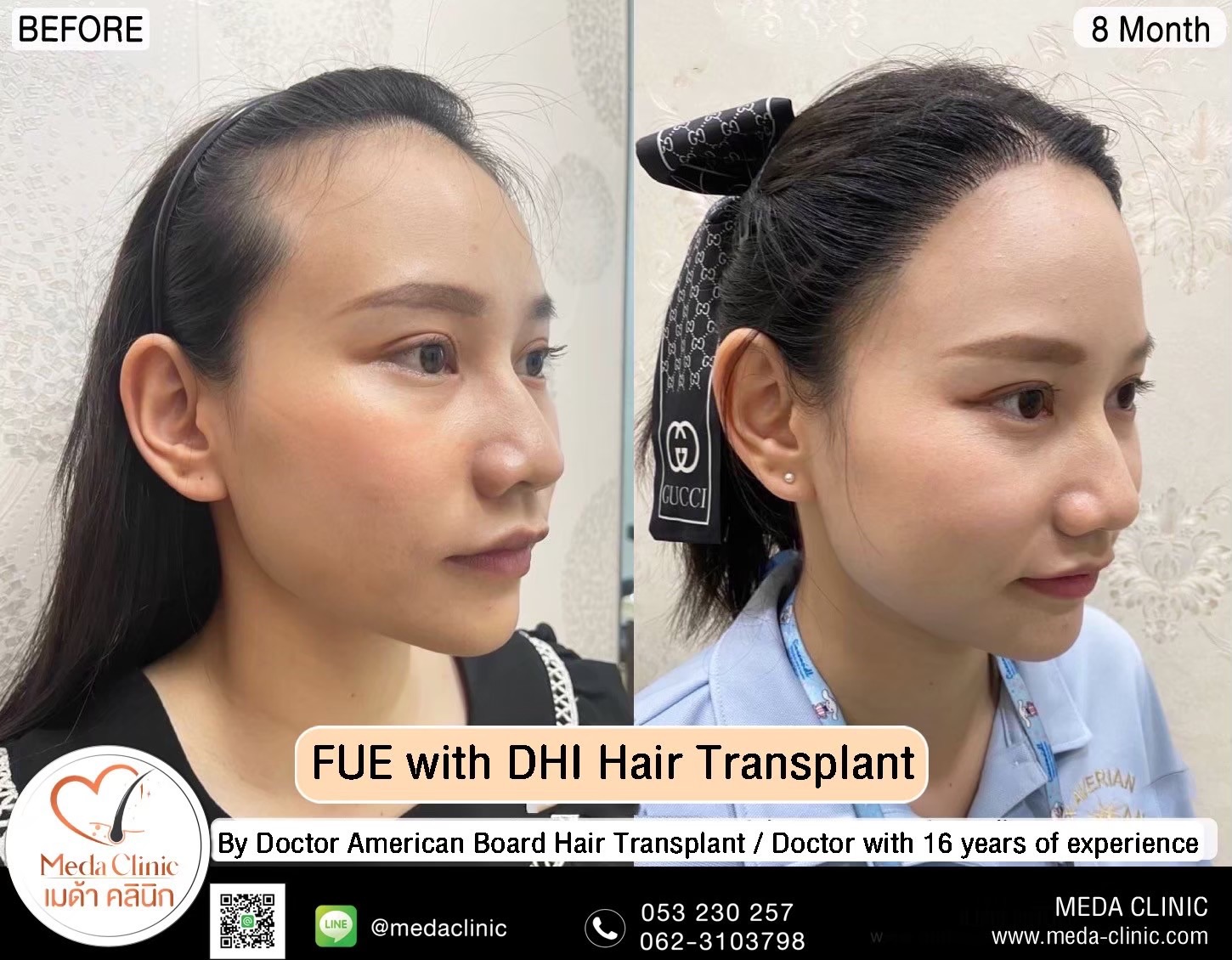 ABHRS hair transplant Thailand