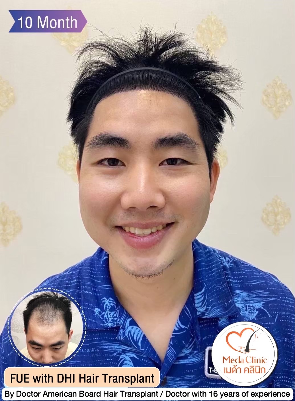 ABHRS hair transplant Thailand