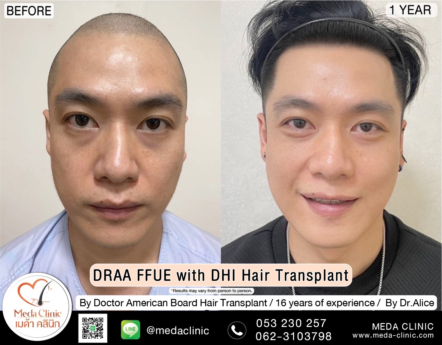 ABHRS hair transplant Thailand