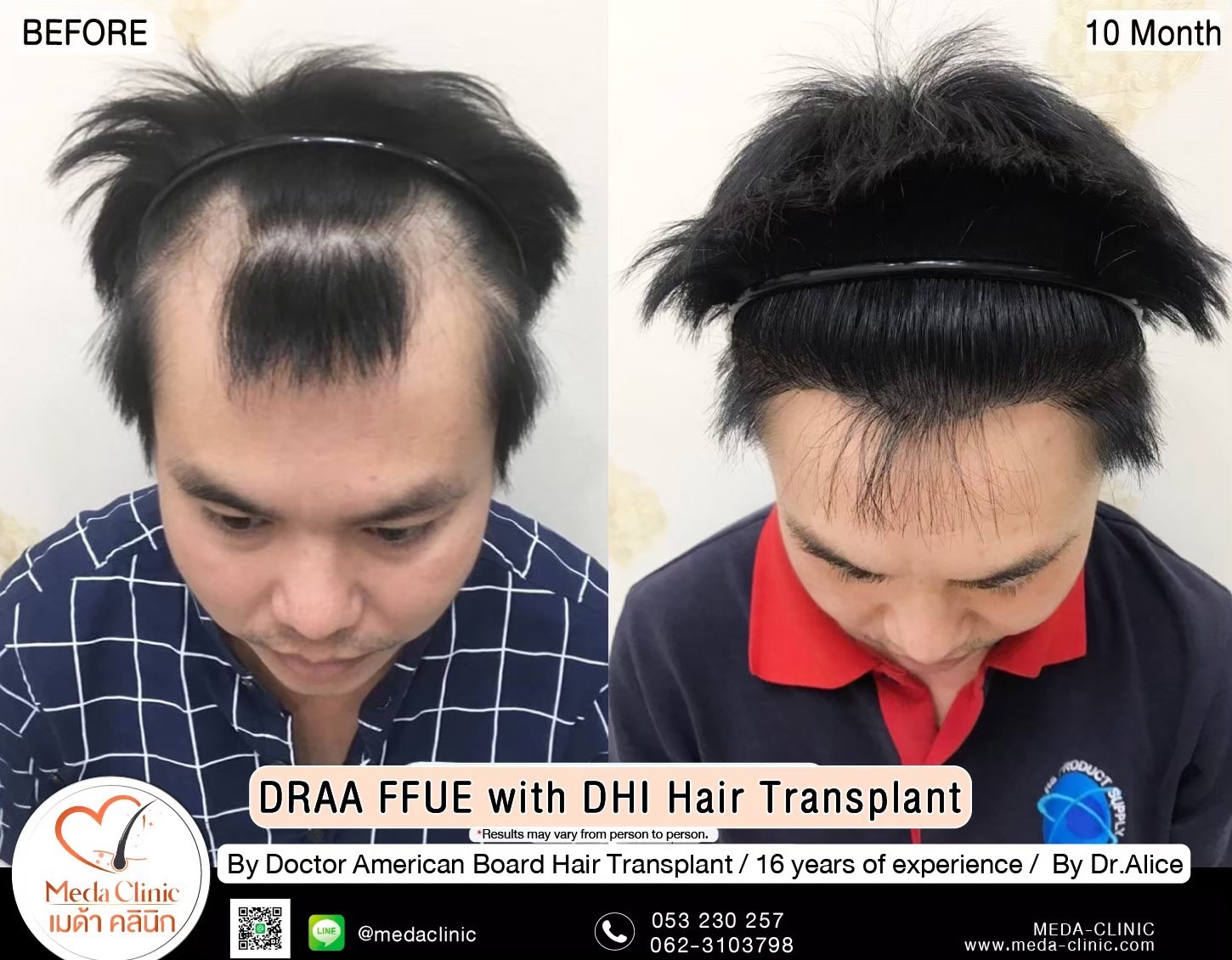 ABHRS hair transplant Thailand