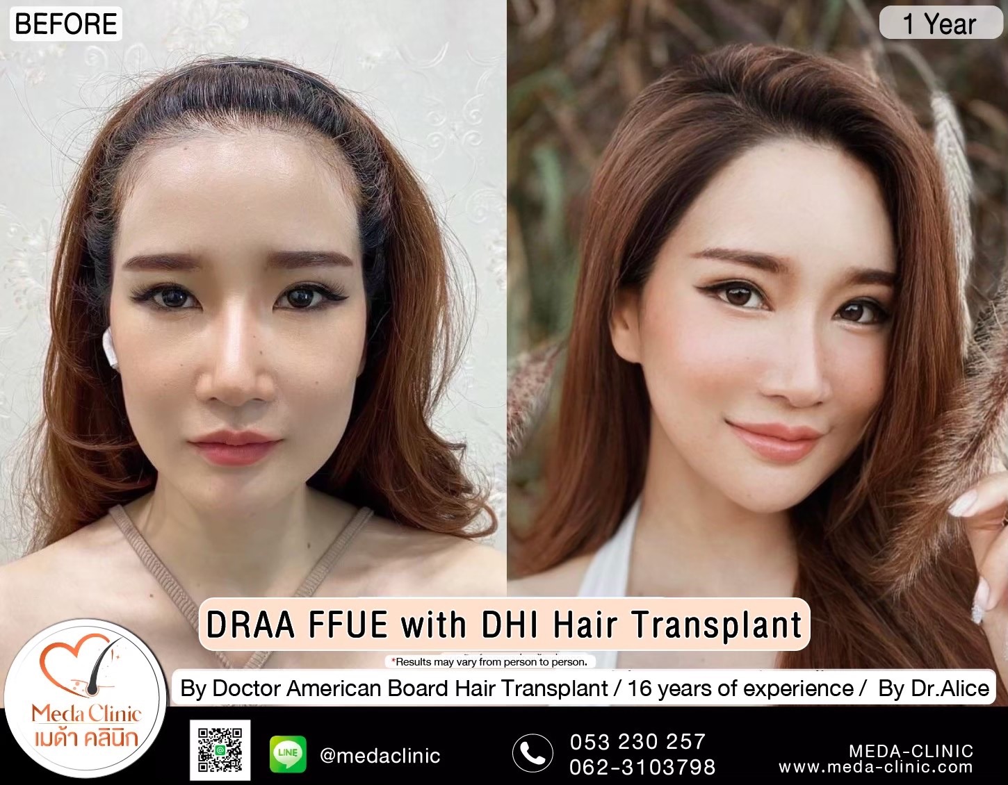 ABHRS hair transplant Thailand