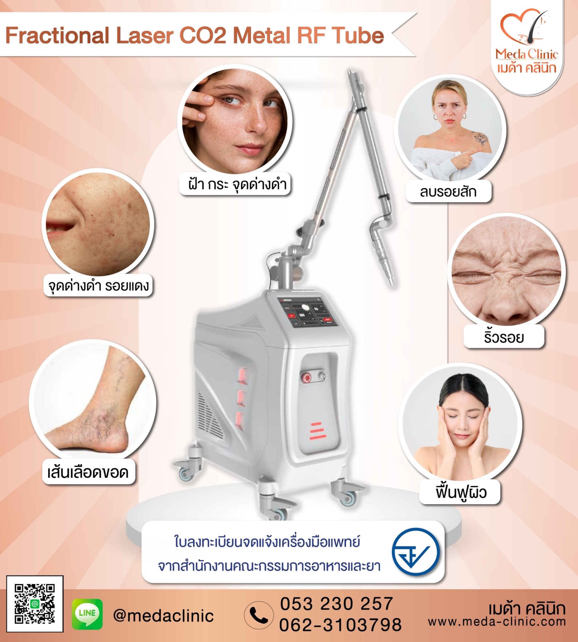 เลเซอร์ฝ้ากระที่ไหนดี