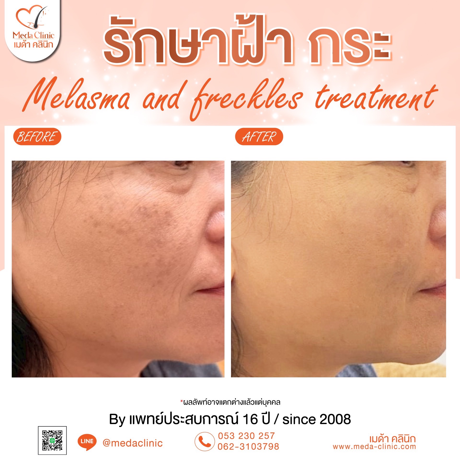 เลเซอร์ฝ้ากระที่ไหนดี