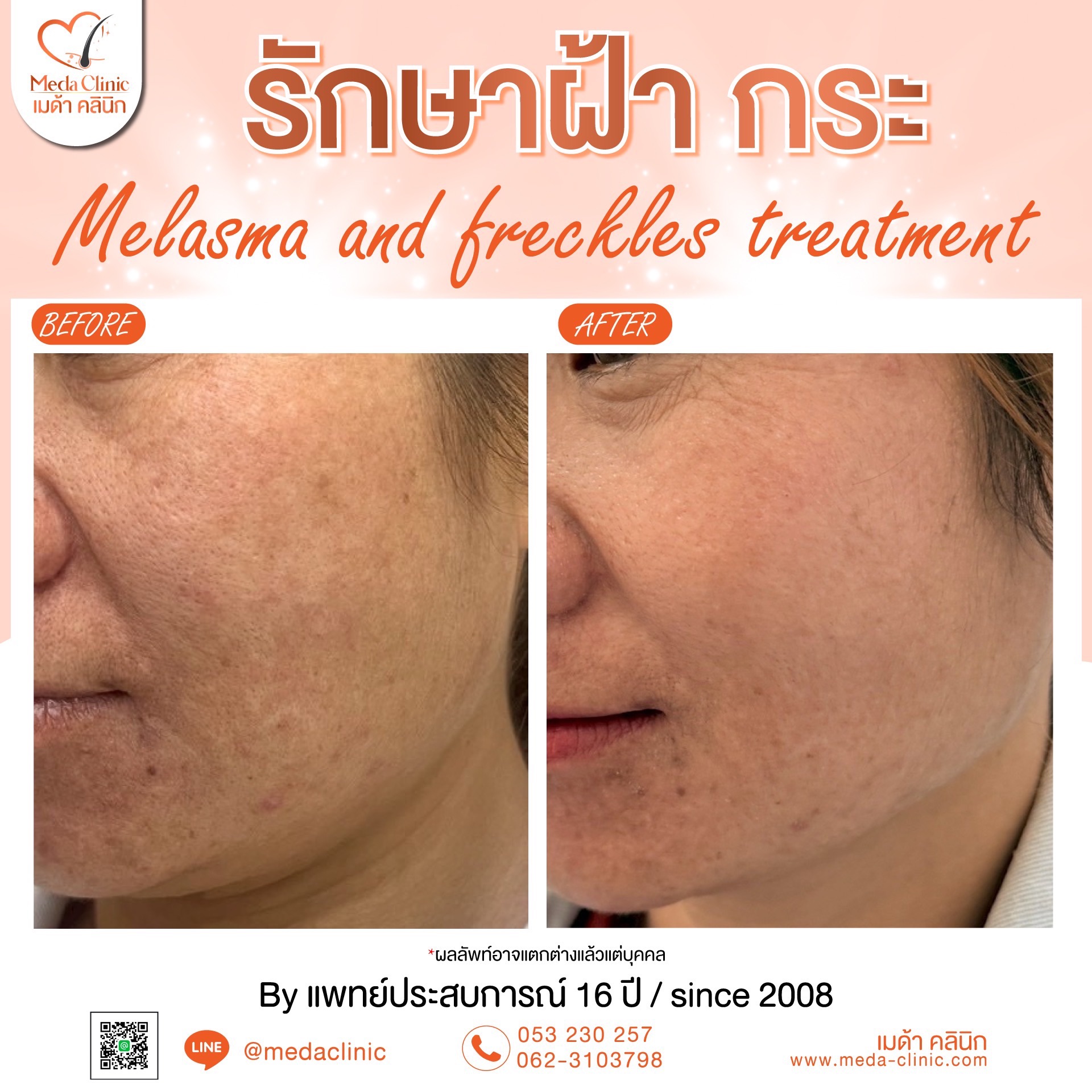 เลเซอร์ฝ้ากระที่ไหนดี