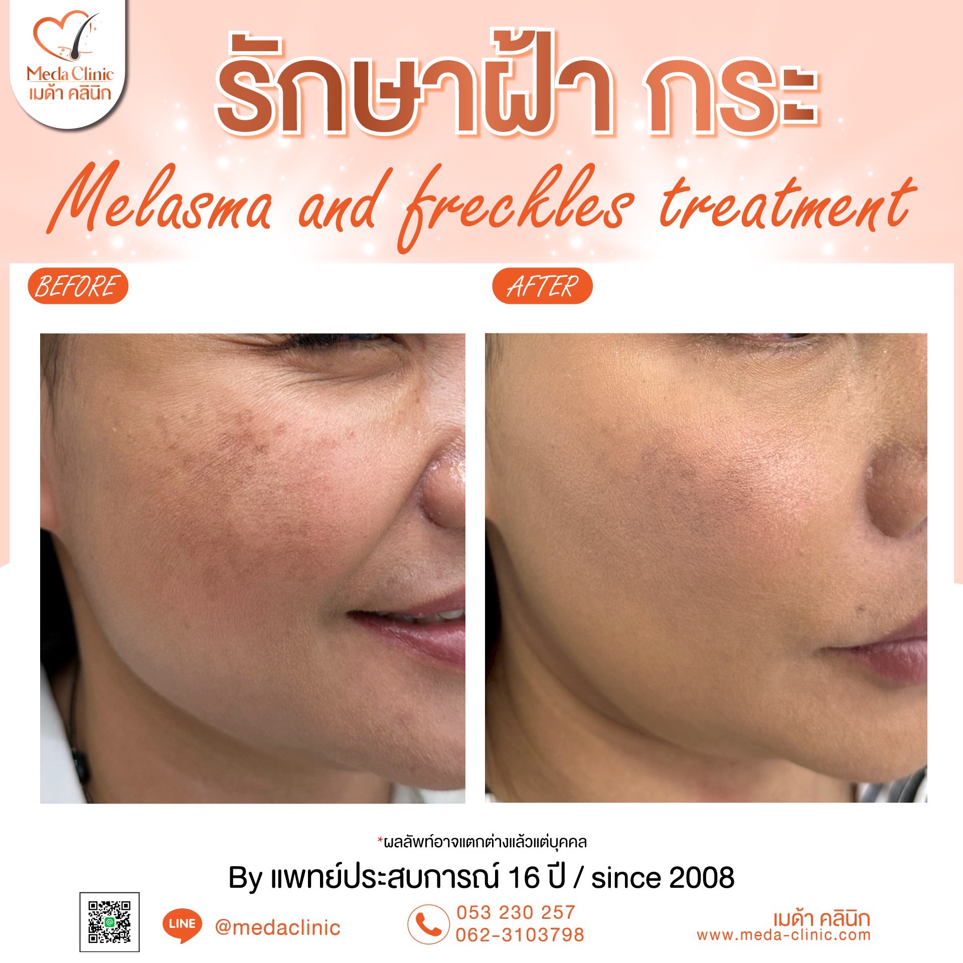 เลเซอร์ฝ้ากระที่ไหนดี