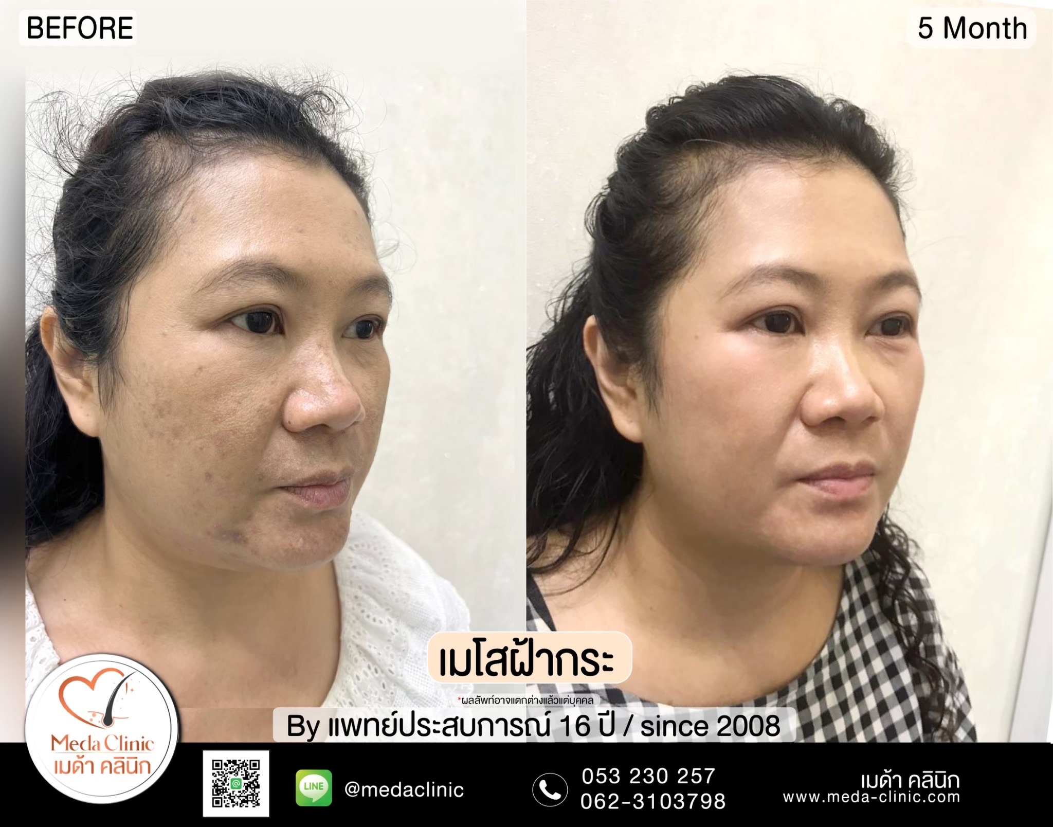 เลเซอร์ฝ้ากระที่ไหนดี