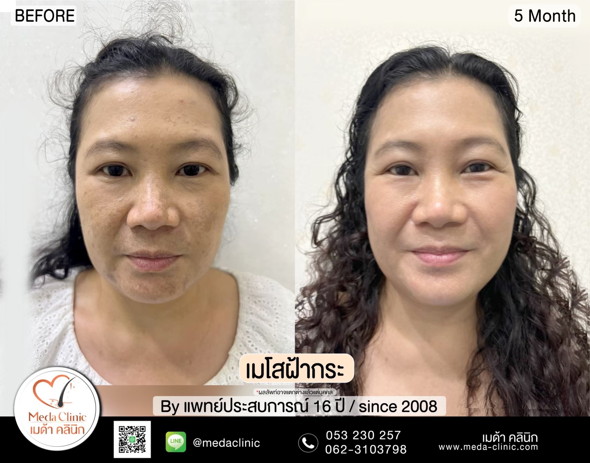 เลเซอร์ฝ้ากระที่ไหนดี