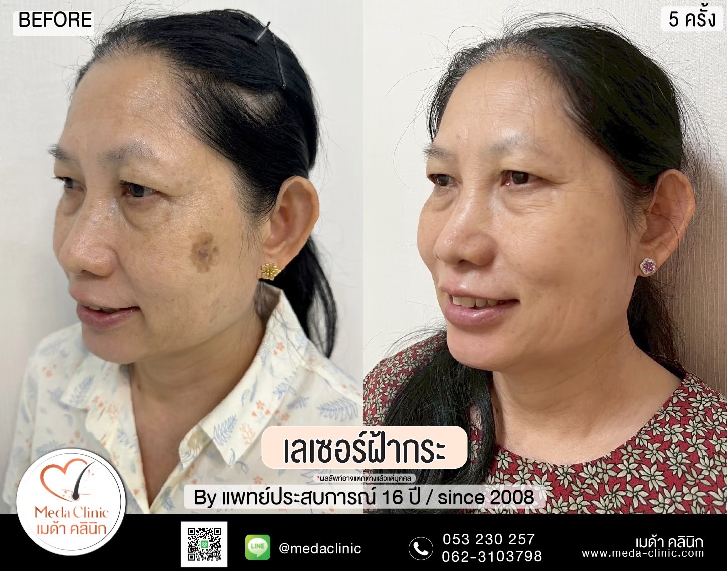 เลเซอร์ฝ้ากระที่ไหนดี