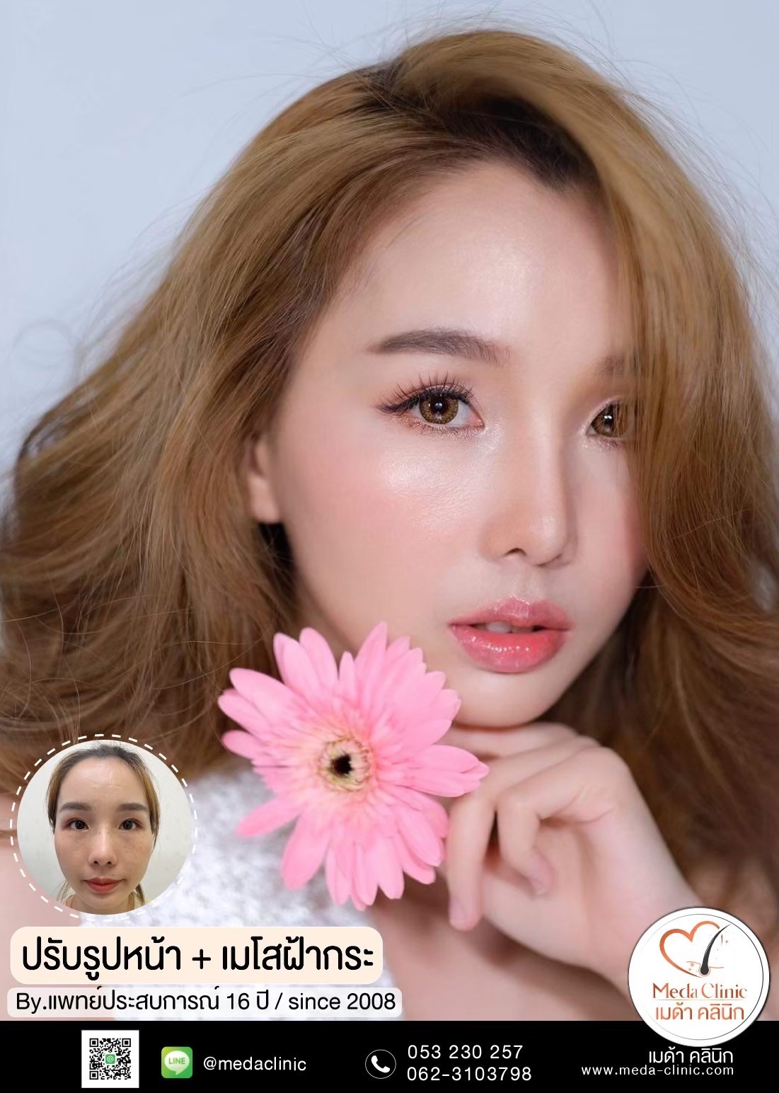 เลเซอร์ฝ้ากระที่ไหนดี