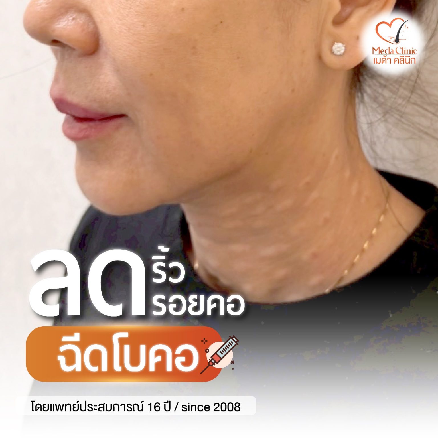 ลดริ้วรอยคอ