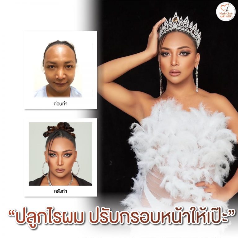 ปลูกผมที่ไหนดี