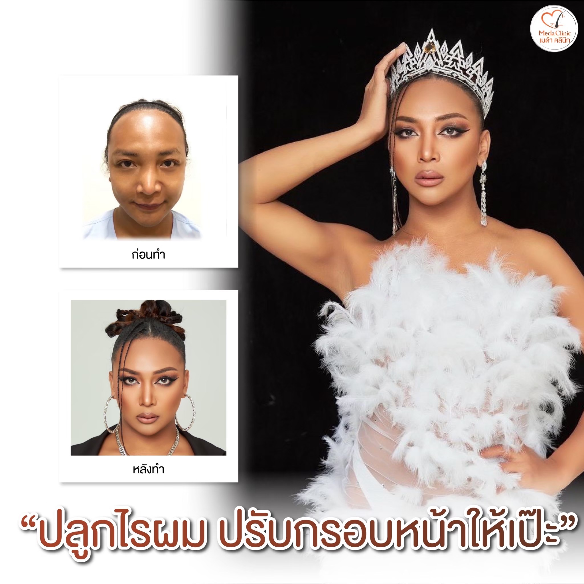 ปลูกผมที่ไหนดี