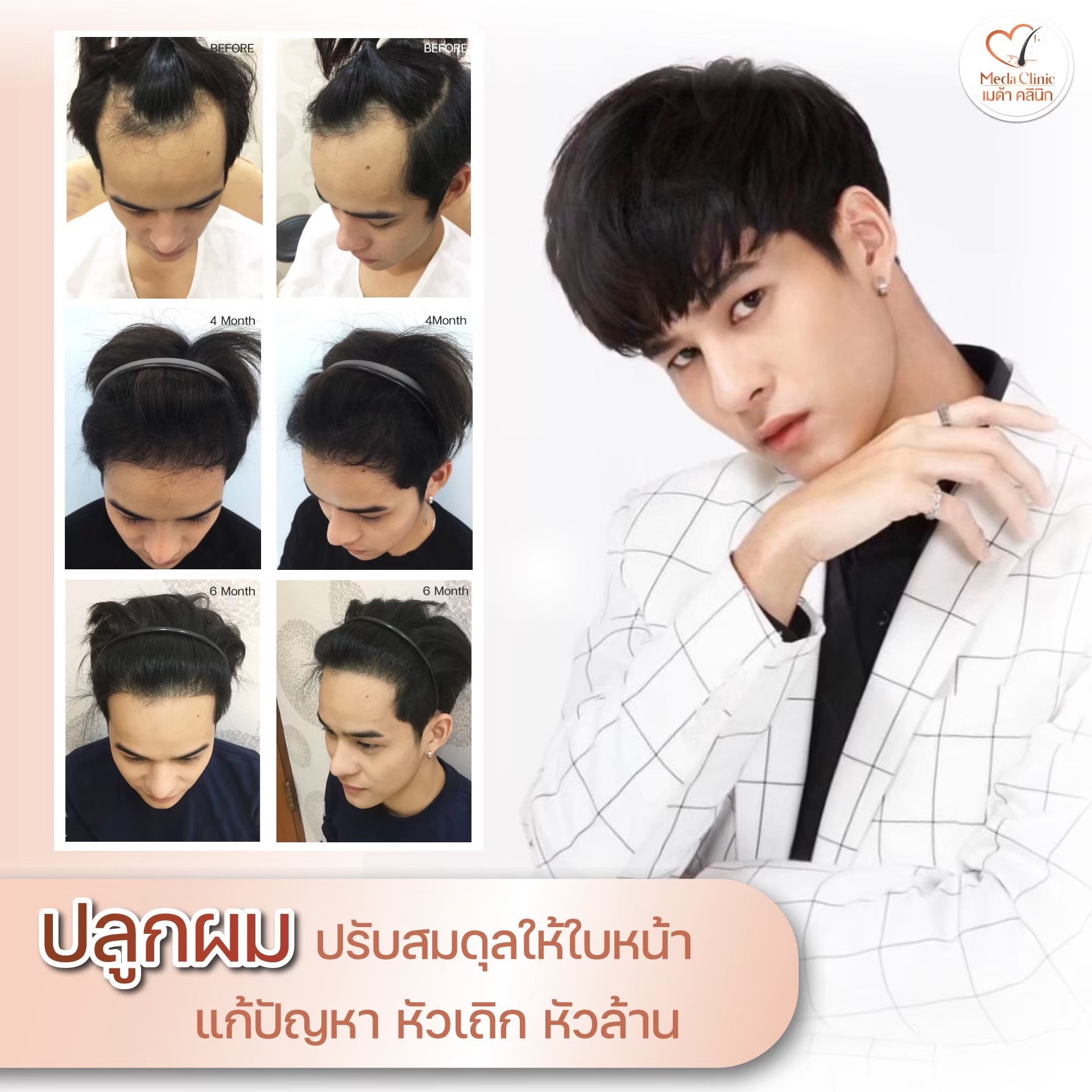 คลินิกปลูกผมที่ไหนดี