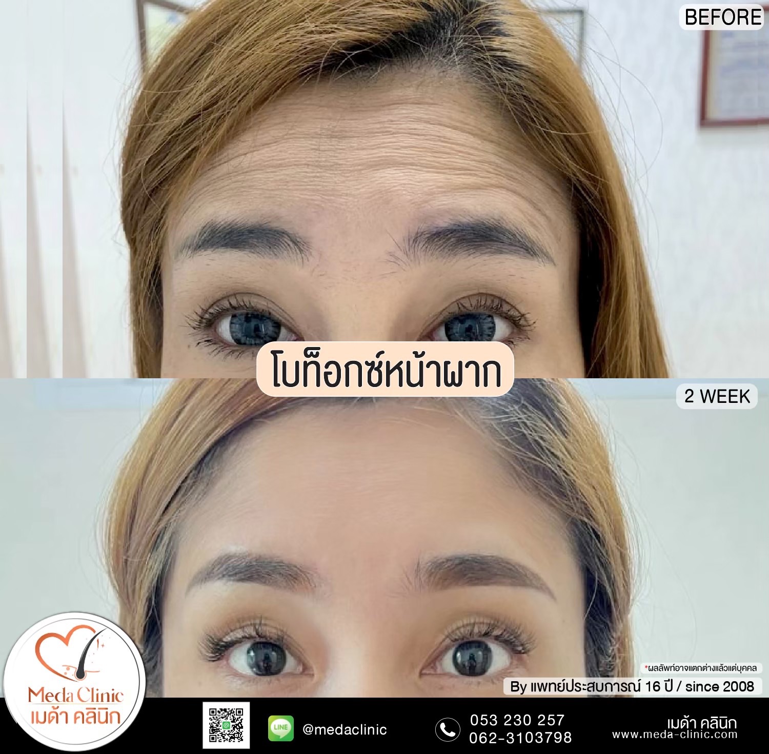 ร้อยไหม