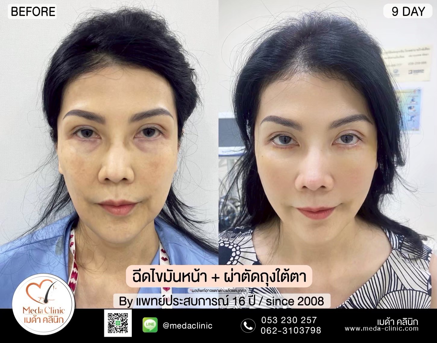 ฉีดไขมันหน้า