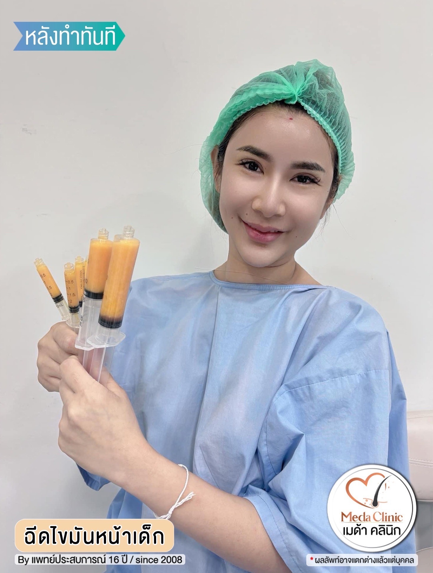 ฉีดไขมันหน้า