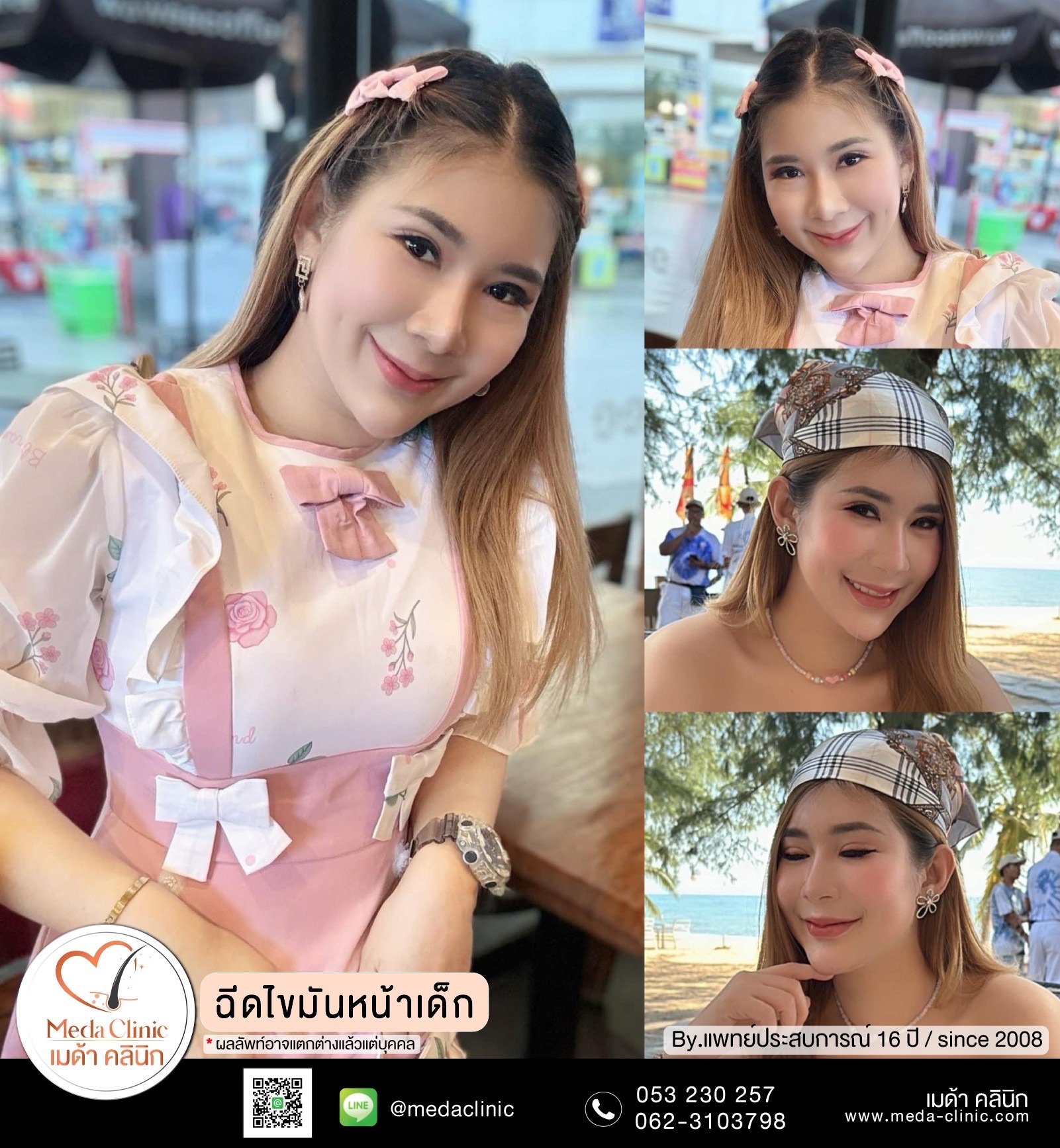 ฉีดไขมันหน้า