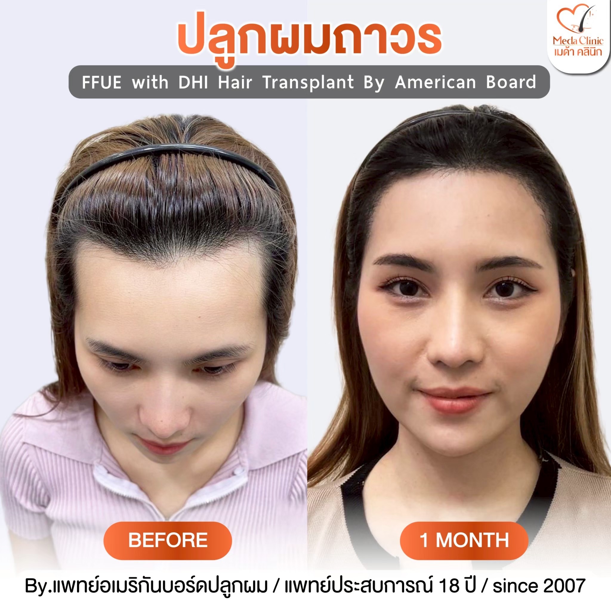 ปลูกผม