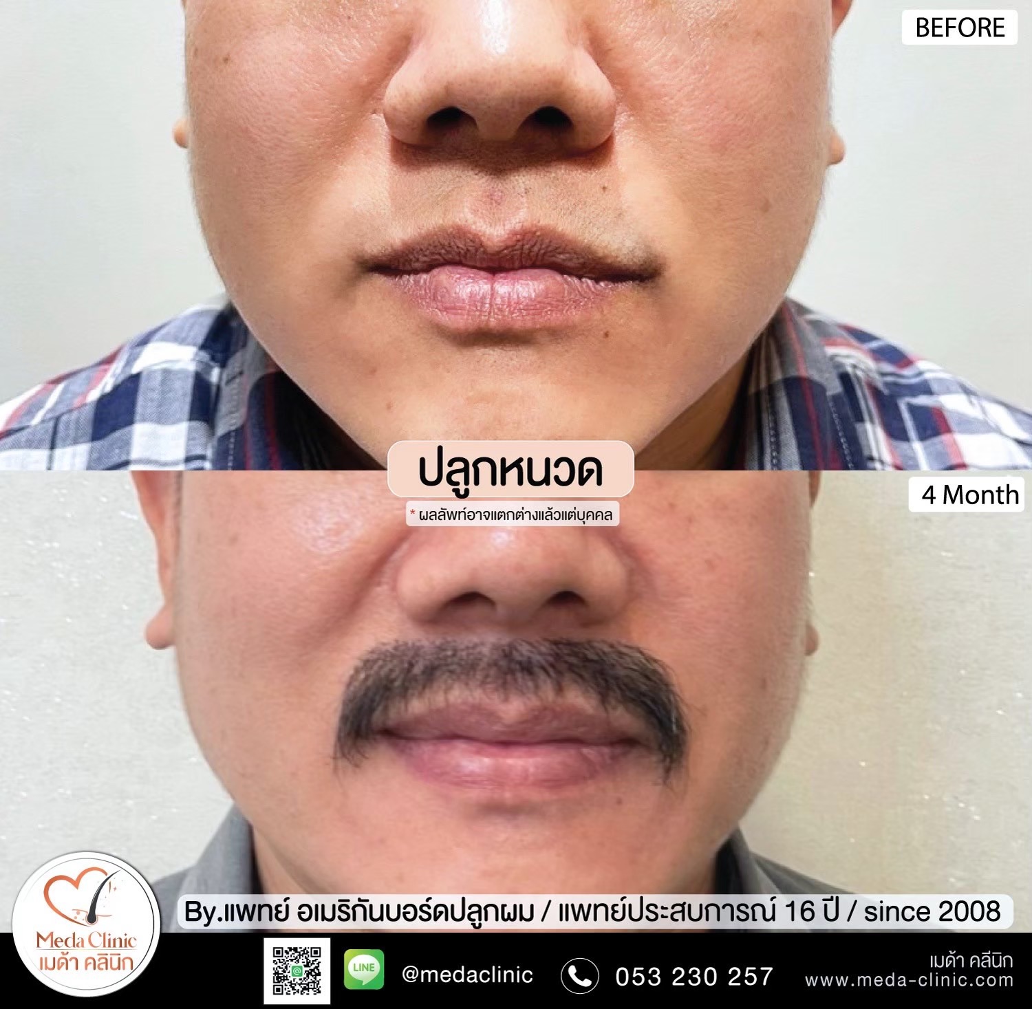 ปลูกหนวดเชียงใหม่